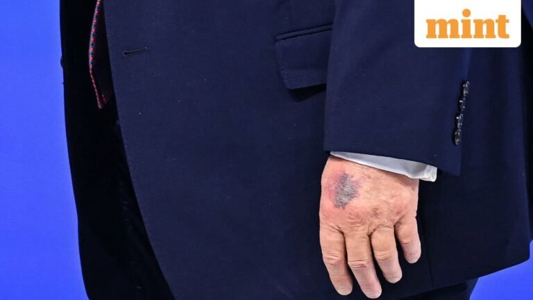 Donald Trump’s latest bruise on his hand has sent the internet into a frenzy; US President Explains – What He Said | Today’s news