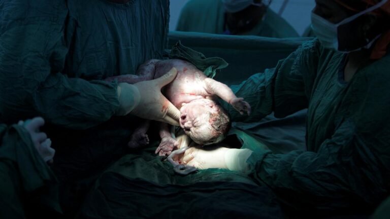 Telangana records the highest C-section rate in India; almost 6 out of 10 babies born via surgery