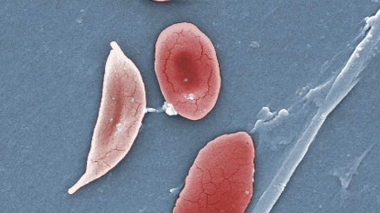 Health Ministry to launch revised Mukt Bharat Anemia Guidelines