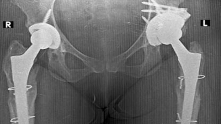 Infections, fractures increasingly lead to repeat hip replacement surgeries, study says